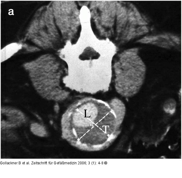 Abdominelles Aortenaneurysma - CT