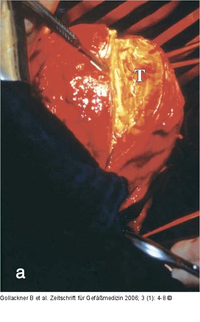 Abdominelles Aortenaneurysma - Intraoperativ