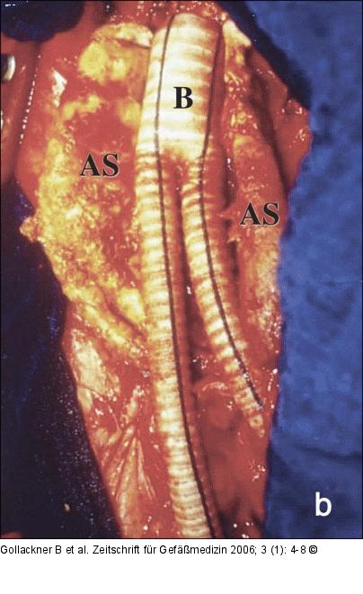 Abdominelles Aortenaneurysma - Intraoperativ