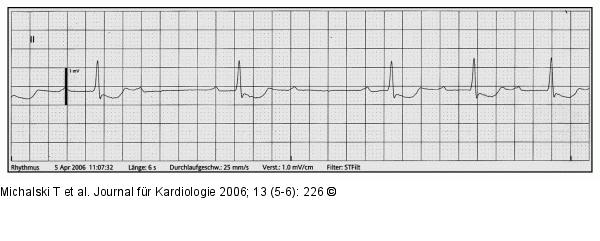 EKG