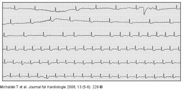 EKG