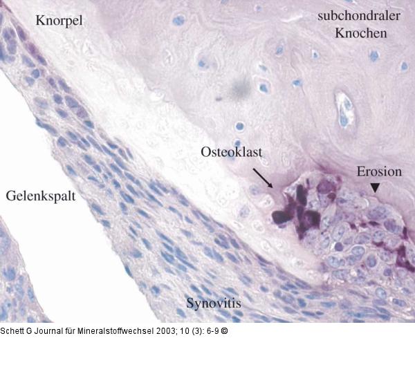Rheumatoide Arthritis - Knochenerosion