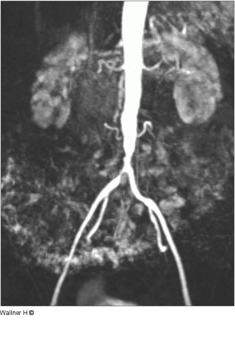 Aortenbifurkationsstenose - Stenose der Arteria iliaca communis