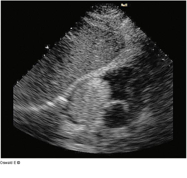 Hochmobiler Tumor