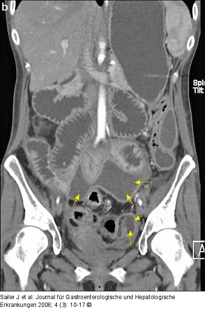 CT-Enteroklysma