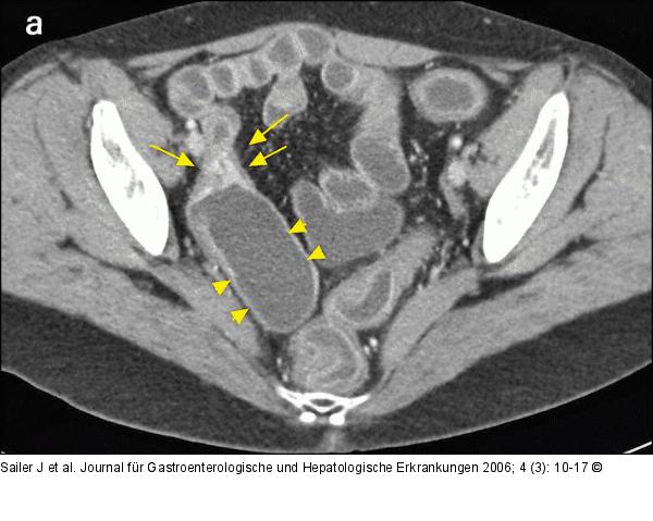 Morbus Crohn-Rezidiv