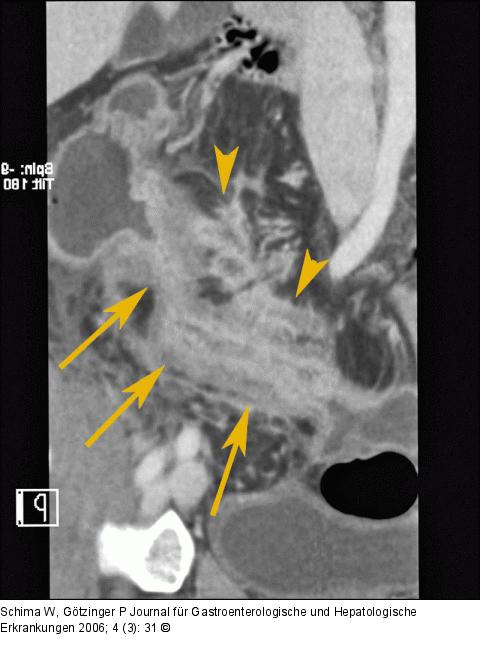 Neoterminales Ileum