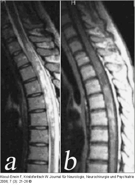 Neuromyelitis optica