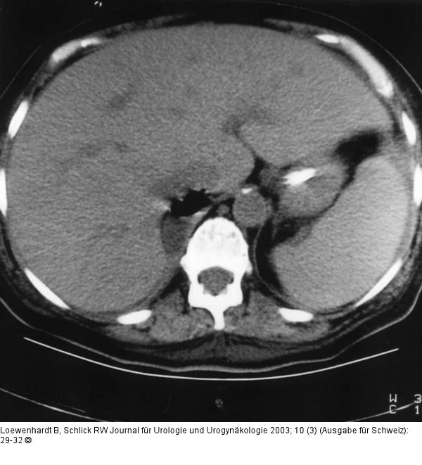Emphysematöse Pyelonephritis