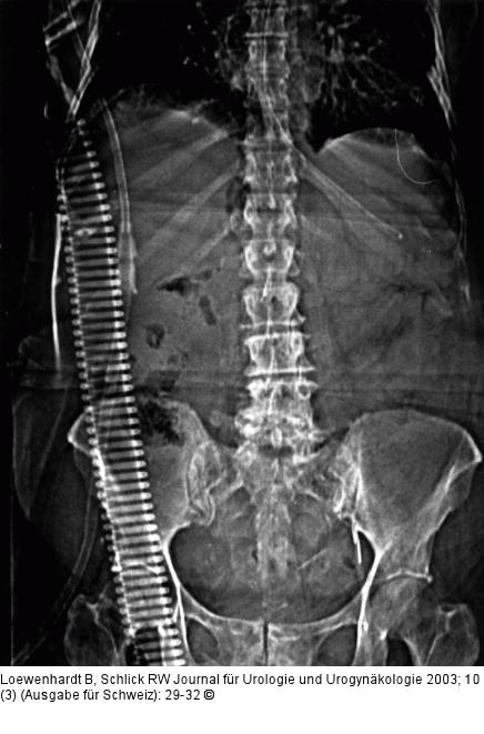 Emphysematöse Pyelonephritis