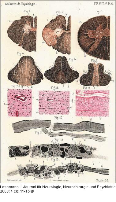 Multiple Sklerose - Pathologie
