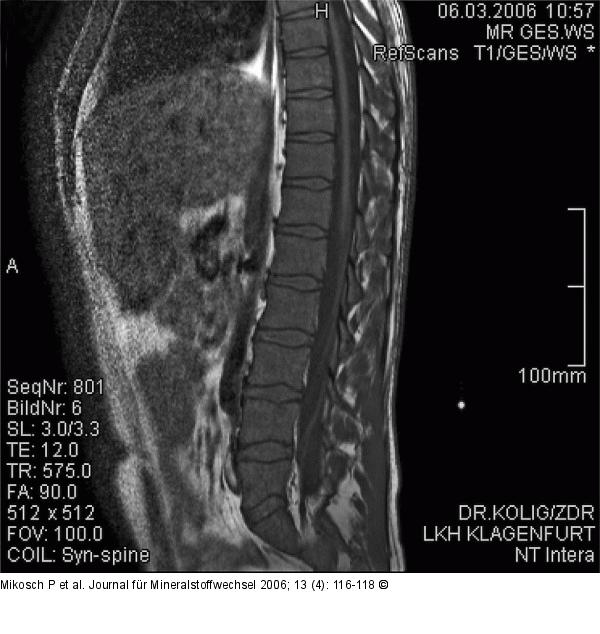 MRI - LWS