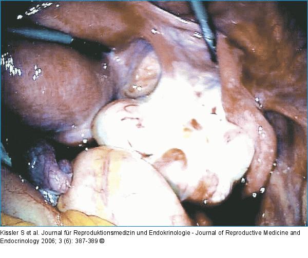 Contralateral right tube
