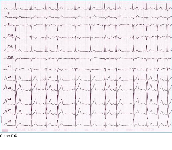 EKG