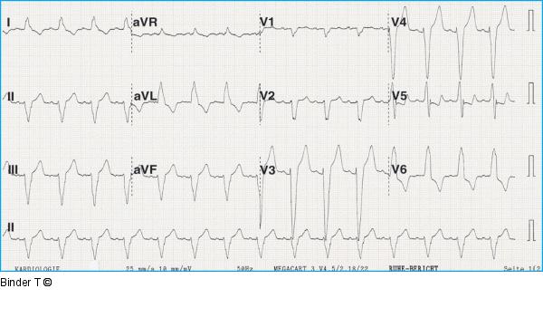 EKG