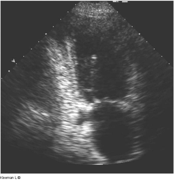 Transthorakales Echo