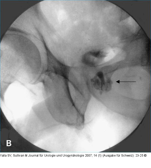Cystourethrogram