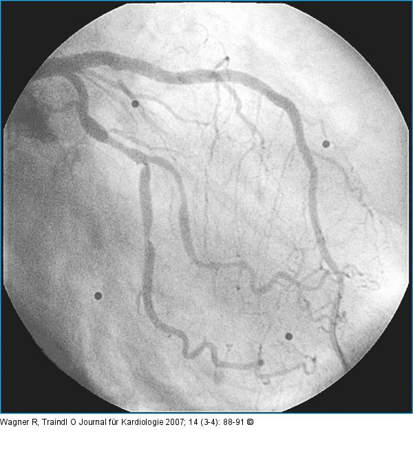 LAD-Stent