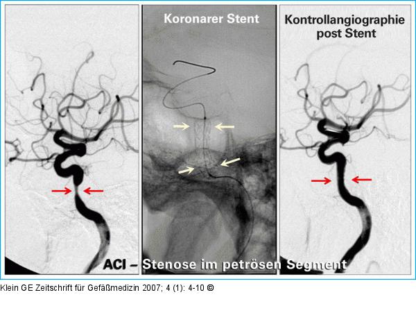 A. carotis interna - Stent