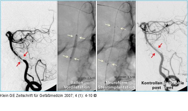 A. basilaris - Stent