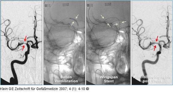 A. carotis interna - Stent