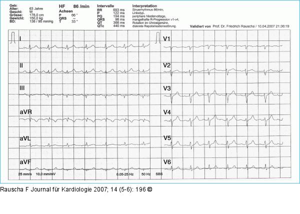 Sinusrhythmus mit peripherer Niedervoltage
