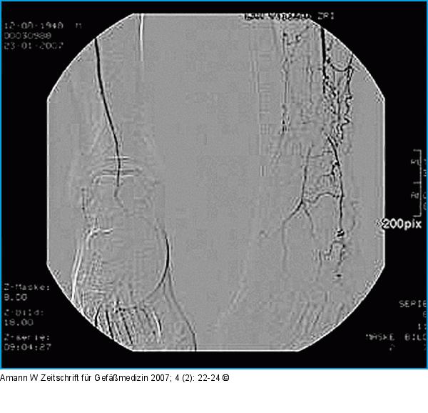 Angiographie