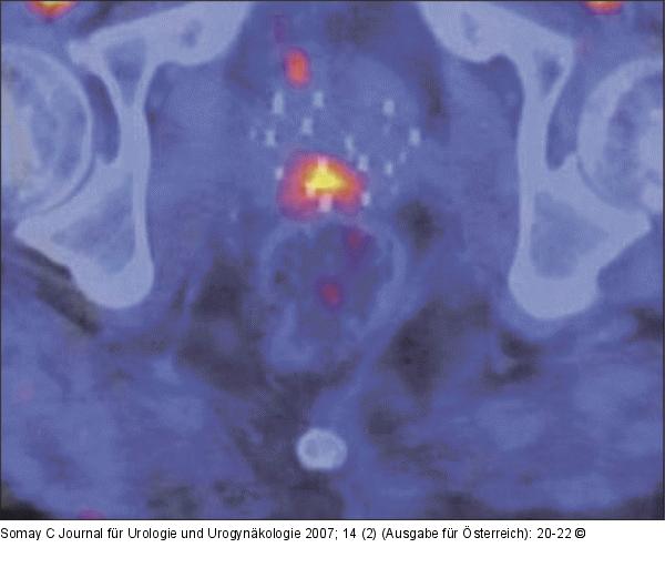 F18-Cholin-PET mit CT-Fusion
