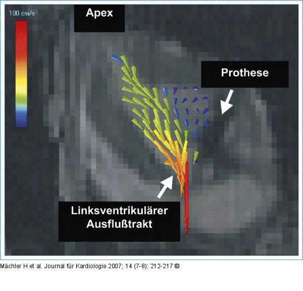 Endsystolischer Strömungscharakter