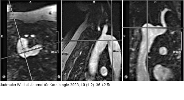 Magnetresonanzangiographie - multiplanare Rekonstruktion