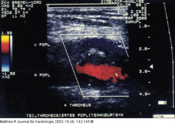 Popliteal Aneurysm
