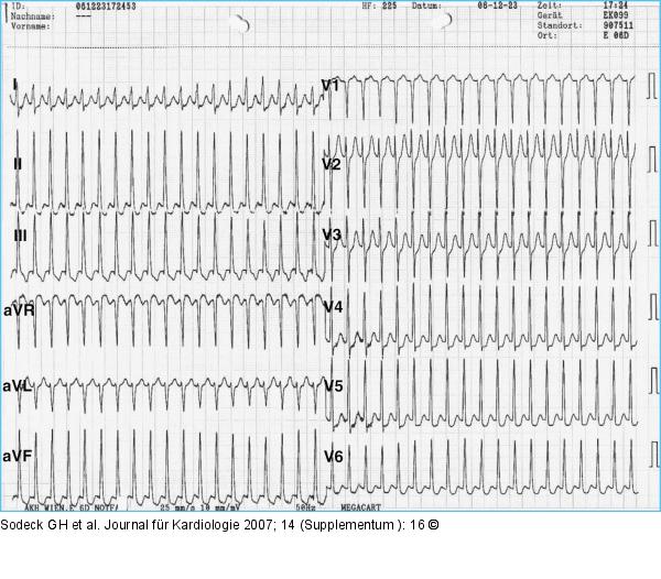 12-Kanal-EKG