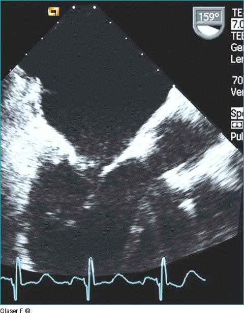 Aorta ascendens