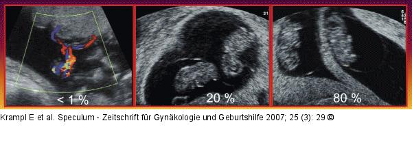 Mehrlingsschwangerschaft