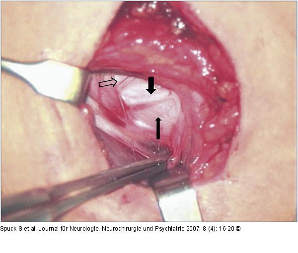 Intraoperativer Situs