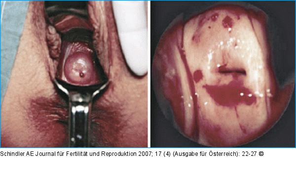 Endometriose
