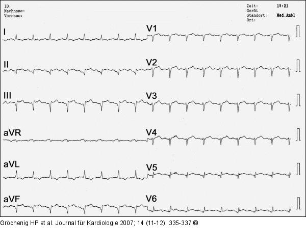 EKG
