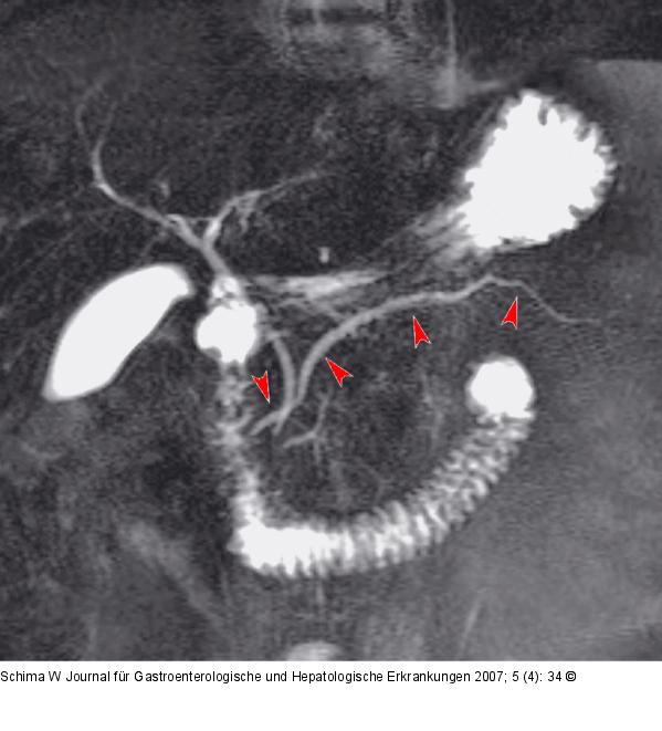 Ductus pancreaticus