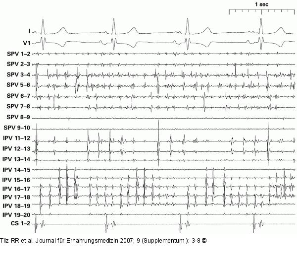 EKG-Ableitung