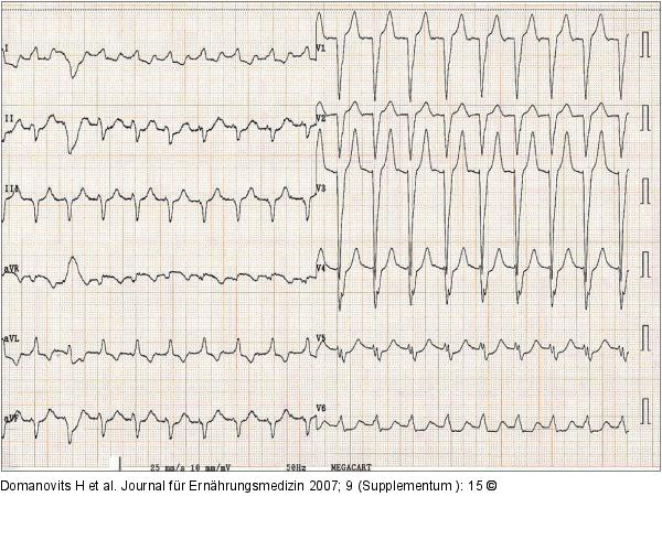 EKG