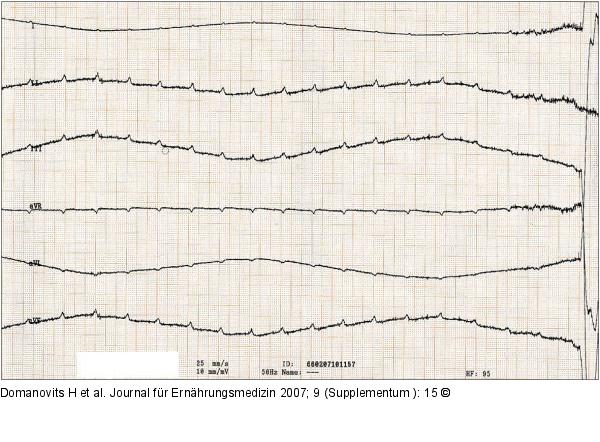EKG