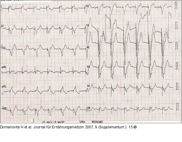 EKG