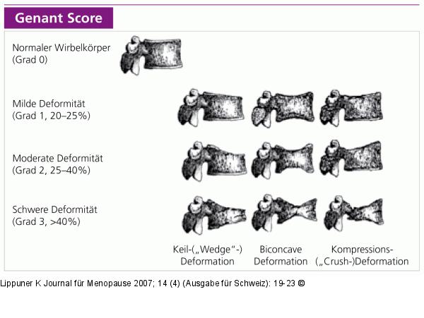 Genant Score