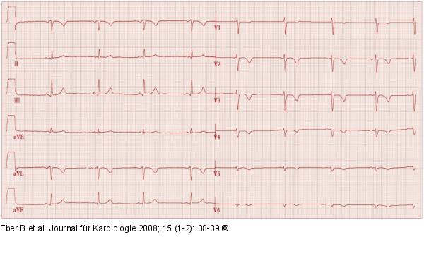 EKG