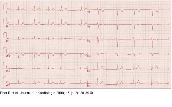 EKG