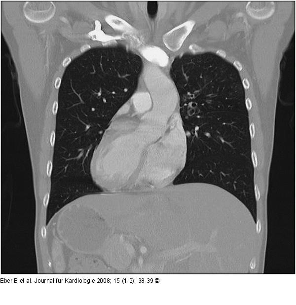 CT-Thorax