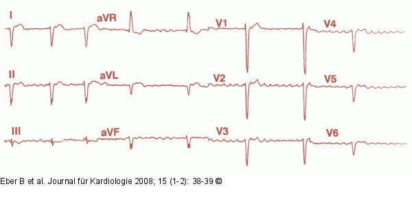 EKG