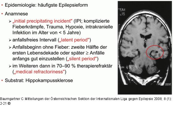 Mesiale Temporallappenepilepsie