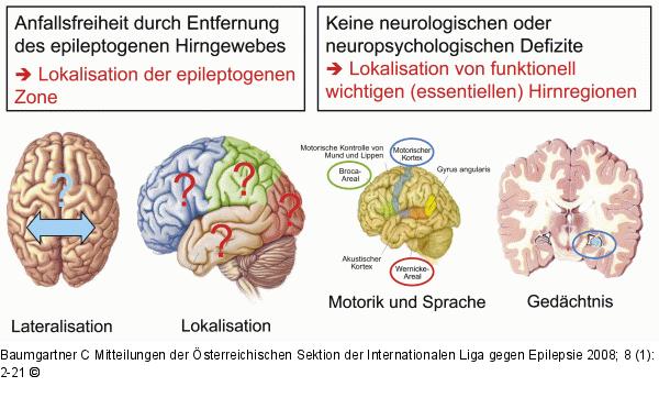 Präoperative Epilepsiediagnostik
