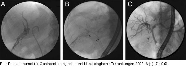 Photodynamische Therapie - Cholangiokarzinom